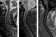 Comparison of Phase Sensitive Inversion Recovery MRI with T2W-TSE and STIR in the Detection of Cervical Multiple Sclerosis Lesions